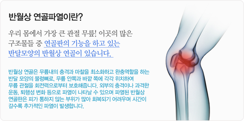 반월상 연골파열이란? 우리 몸에서 가장 큰 관절 무릎! 이곳의 많은 구조물들 중 연골판의 기능을 하고 있는 반달모양의 반월상 연골이 있습니다. 반월상 연골은 무릎내의 충격과 마찰을 최소화하고 완충역할을 하는 반달 모양의 물렁뼈로, 무릎 안쪽과 바깥 쪽에 각각 위치하여 무릎 관절을 회전력으로부터 보호해줍니다. 외부의 충격이나 과격한 운동, 퇴행성 변화 등으로 파열이 나타날 수 있으며 파열된 반월상 연골판은 피가 통하지 않는 부위가 많아 회복되기 어려우며 시간이 갈수록 추가적인 파열이 발생합니다.